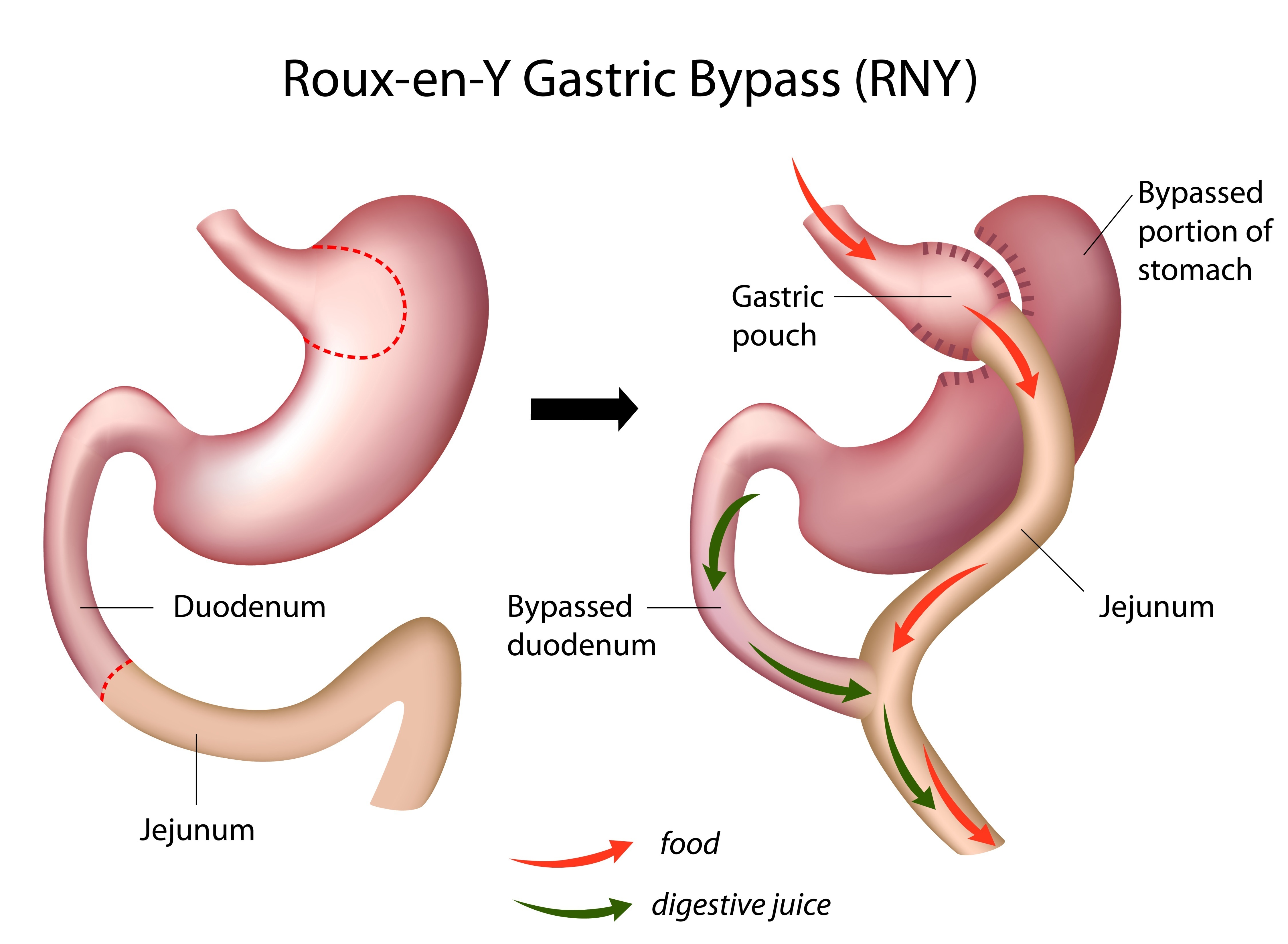 bypass gastrique laparoscopique