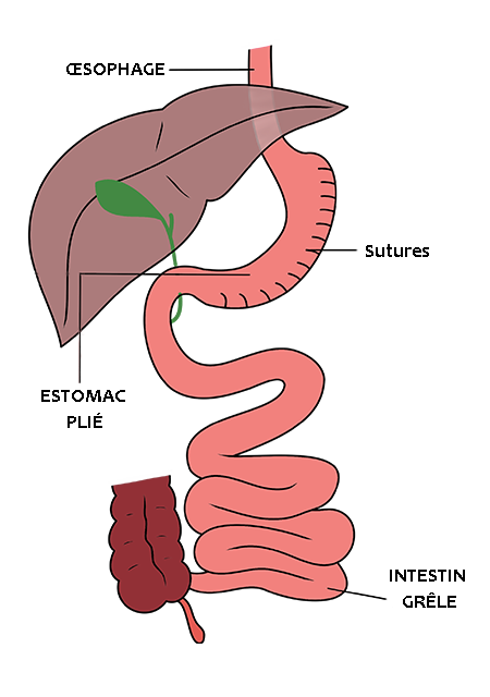 Schéma d'une Plicature gastrique