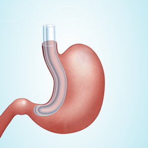 sleeve gastrectomie pose de la sonde gastrique