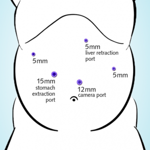 Sleeve gastrique incisions paroi abdominale et introduction des trocarts
