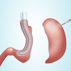 sleeve gastrique resection de l'estomac
