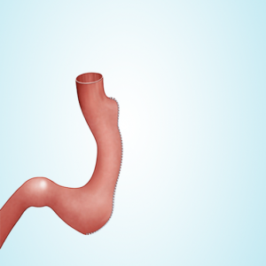 sleeve gastrectomie tube gastrique nouvel estomac
