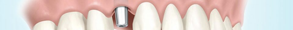 Implants dentaires
