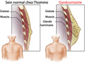 gynécomastie anatomie