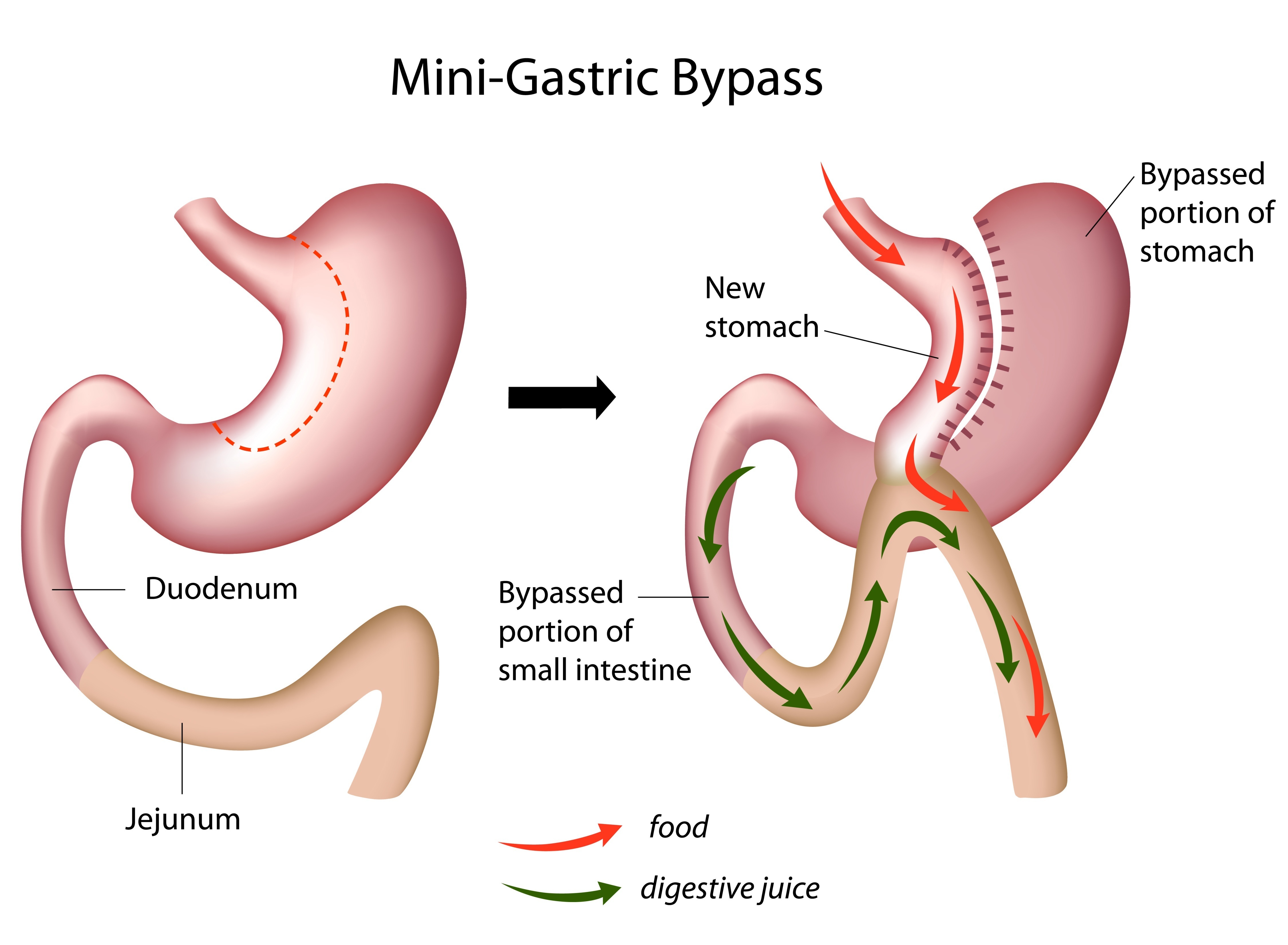 mini bypass gastrique