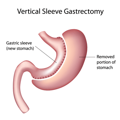 Sleeve gastrique en Tunisie